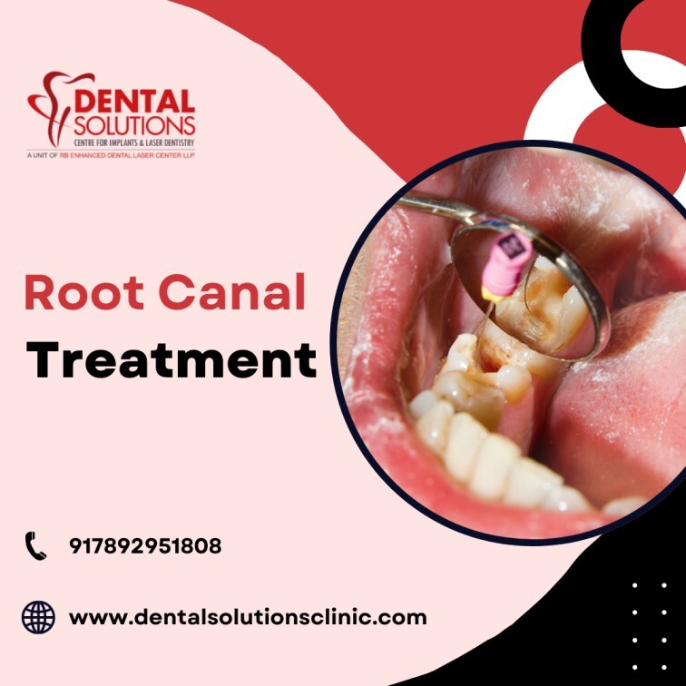 Root Canal Treatment in Bangalore at Dental Solutions