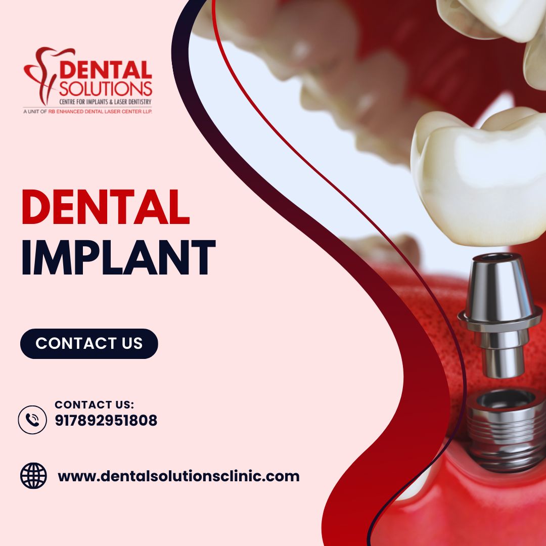 Dental Implant Cost in Bangalore from Dental Solutions