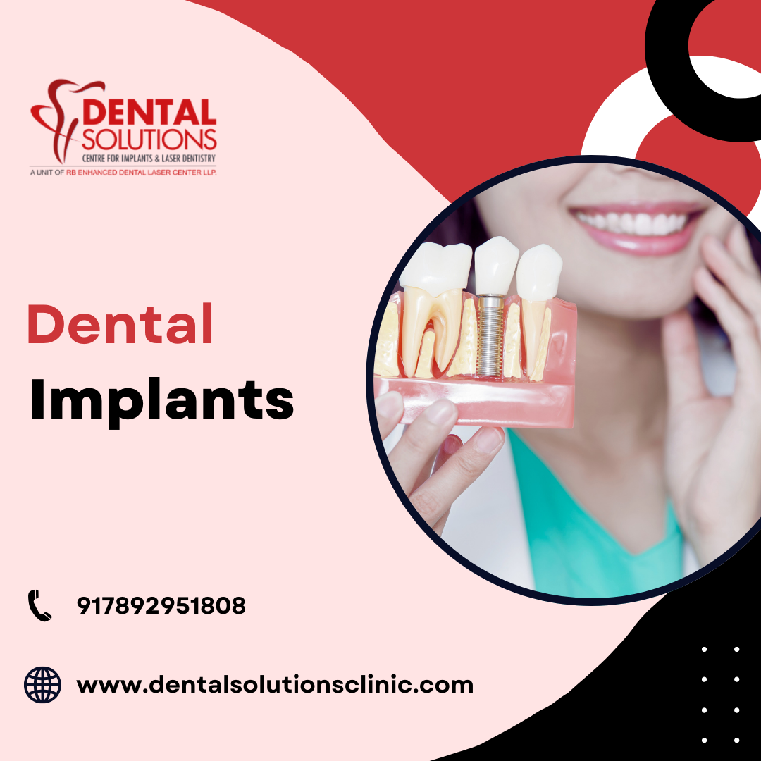 Dental Implants in Bangalore from Dental Solutions