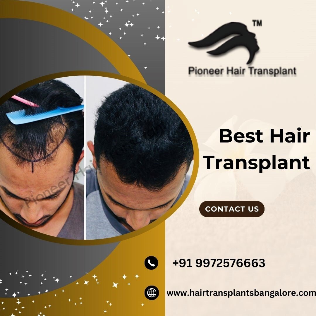 Best Hair Transplant in Bangalore-Pioneer