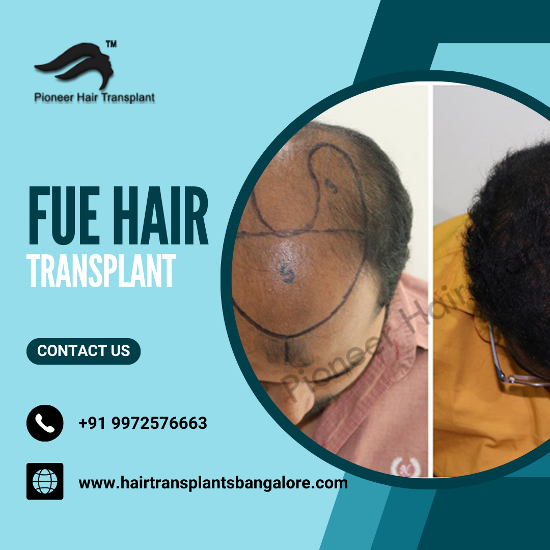 Fue Hair Transplant Cost in Bangalore from Pioneer