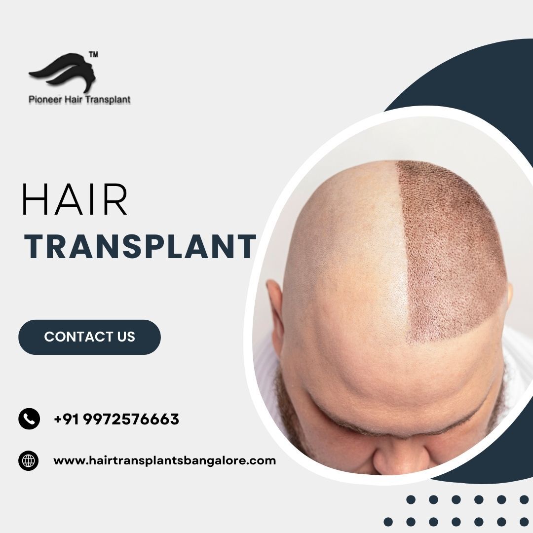 The Ultimate Guide to Hair Transplant in Bangalore: Pioneer's Expertise Unveiled