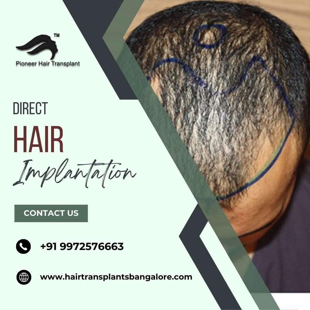 Direct Hair Implantation in Bangalore from Pioneer