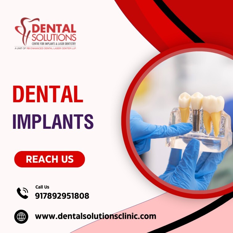 Cost of Dental Implants in Bangalore-DentalSolutions