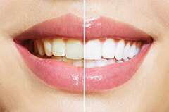 Cosmetic Dentist | Smile makeovers with whiteing, veneers or cro