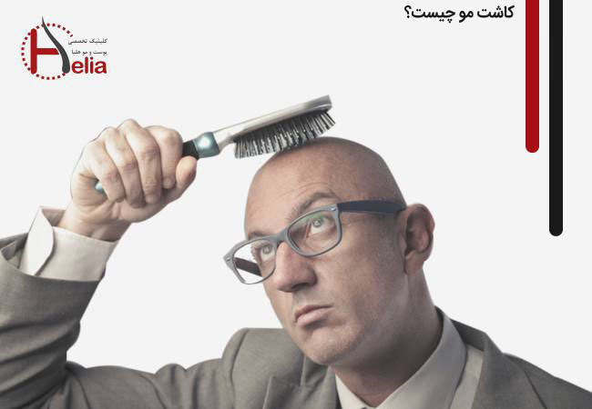 کاشت مو - راهنمای معتبر چگونگی پیوند موی سر در سال ۱۴۰۰ | کلینیک