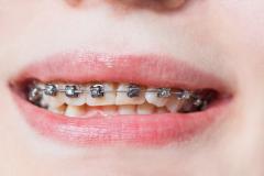 Self-ligating Braces Vs Conventional Braces - Self Ligating Brac