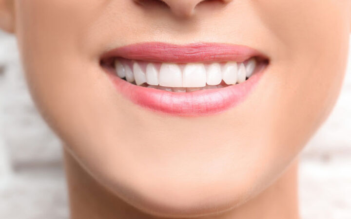 What is cosmetic tooth bonding?