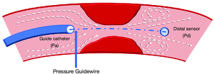 Fractional Flow Reserve Market 2022-27: Size, Share, Price Trends and Research Report