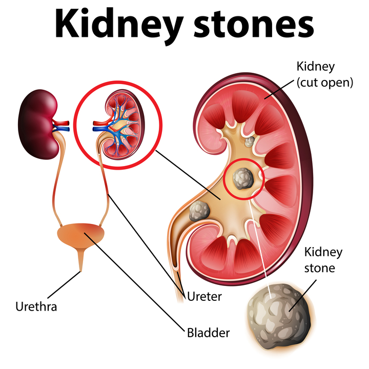 Kidney Stone Cause and the Cost of Surgery in India