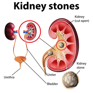Kidney Stone Cause and the Cost of Surgery in India