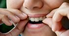 Is A Dental Implant Procedure Suitable For Everyone?