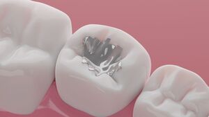 Why Tooth-Colored Fillings Are the Best Choice for Your Smile