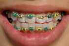 The Perfect Braces Color For Your Teeth