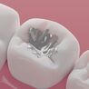 Why Tooth-Colored Fillings Are the Best Choice for Your Smile