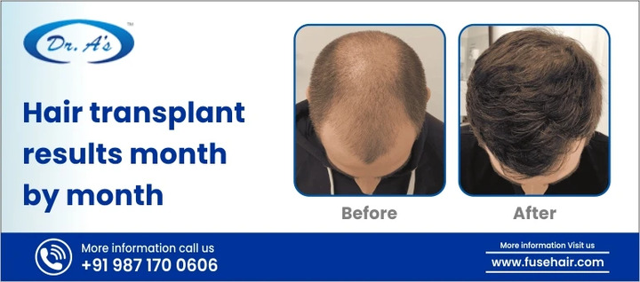 Understanding Hair Transplant Results: A Month-by-Month Guide