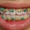 The Perfect Braces Color For Your Teeth