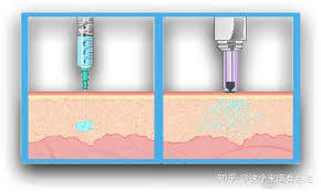 What will be the usage of Needleless Injection in the future?