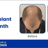 Understanding Hair Transplant Results: A Month-by-Month Guide