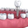 Ditch the Dentures! Why Dental Implants Are the Modern Solution