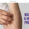 How Do Warts Spread and How Can You Prevent This?