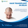 Unveiling the Secrets of Hair Transplants: A Mini Blog
