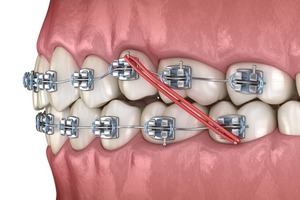 United States Orthodontics Market Growth, Analysis, Industry Forecast, &amp; Outlook Report 2024-2032