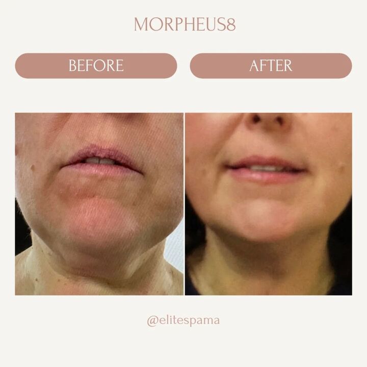 Morpheus8 in Newton MA