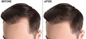 Basic Facts About Organin Hair Loss Treatment