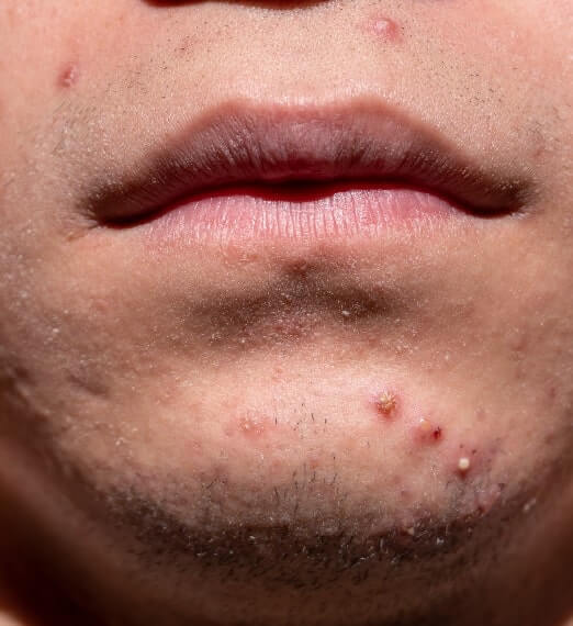 What Causes Acne on Forehead and Nose? 