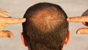 Alopecia Treatment Market Industry Size, Growth, Trends, Share, Analysis and Forecast 2021-2026