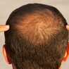 Alopecia Treatment Market Industry Size, Growth, Trends, Share, Analysis and Forecast 2021-2026