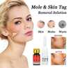 Best Skin Tag And Mole Removing Process is Easy to achieve