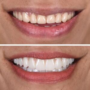 Transform Your Smile with Dental Implants and All-on-4 Solutions in Brisbane
