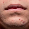 Acne Treatment by a Leading Skin Specialist at Charma Clinic