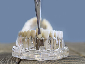 The Role of Bone Density in Dental Implant Success Perth
