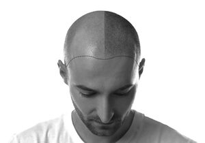Get Scalp Micropigmentation Done With Expert Hands Via Made Hair Academy