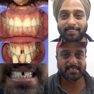 How to do Dental Care in Noida with Purpledent