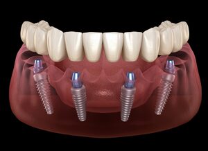 Conceptos Err\u00f3neos Comunes Sobre Implantolog\u00eda Dental