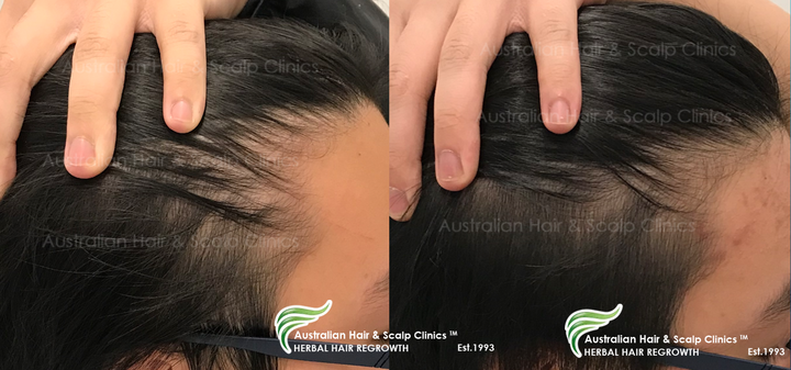 A Safe and Effective Solution for Natural Hair Regrowth