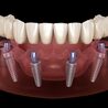 Conceptos Err\u00f3neos Comunes Sobre Implantolog\u00eda Dental