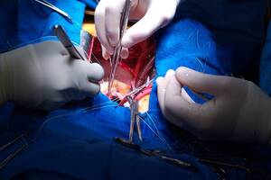 Undergoing Heart Failure Surgery Can Increase Chances of Survival