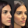 Maintaining Results After Rhinoplasty: Tips for Long-Term Nose Health in Dubai