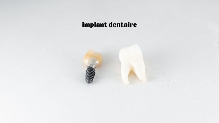 Quels soins post-implantaires suivre après la pose d’un implant dentaire ?