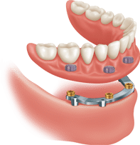 Eat, Speak, Smile with Confidence: Unveiling the Power of Implant Dentures