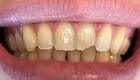 How Long Do Teeth Veneers Last?