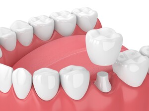 What is All-on-4 Dental Implant Procedure?