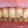 How Long Do Teeth Veneers Last?