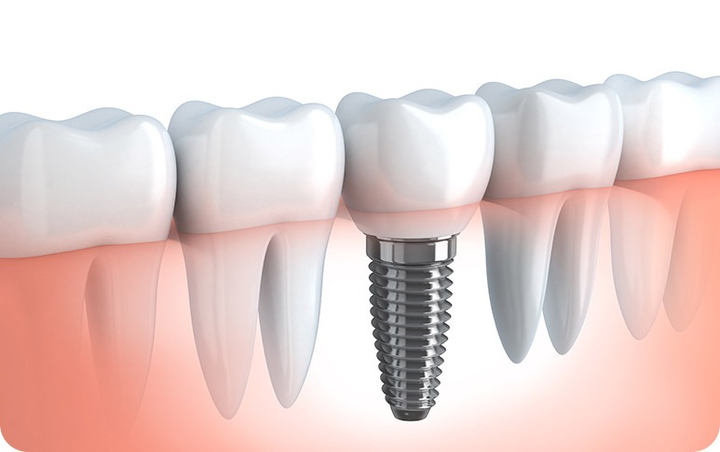 The Ultimate Guide to Dental Implants: What You Need to Know