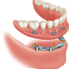 Eat, Speak, Smile with Confidence: Unveiling the Power of Implant Dentures